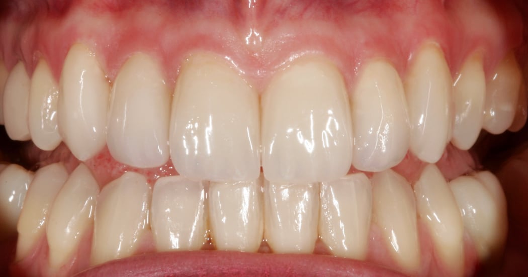 Intraoral_nachher_04