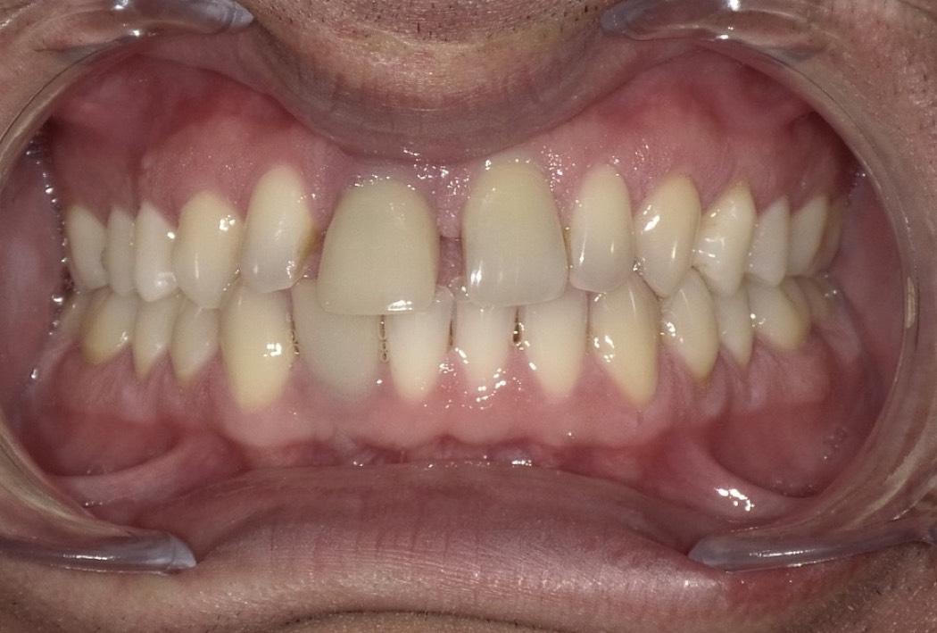 Intraoral_vorher_03